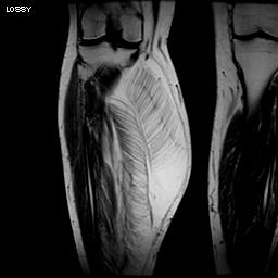 Angiolipoma MRI0001